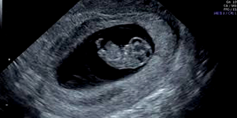 EARLY PREGNANCY SCAN
